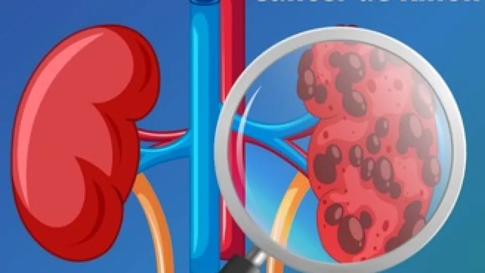 Invitan a prevenir el cáncer de riñón que afecta principalmente a personas mayores de 50 años