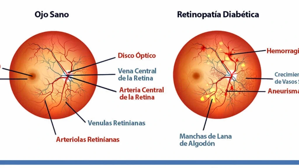 UNAM Revoluciona Tratamiento Ocular: Gotas de Vasoinhibina Contra la Ceguera por Diabetes, Alternativa a Inyecciones Dolorosas
