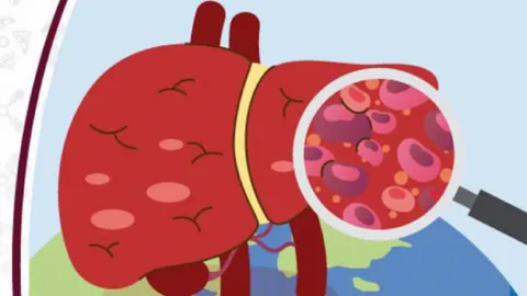 Hepatitis Viral: La OMS Alerta sobre 1.34 Millones de Muertes Anuales y Urge Acciones Globales para su Eliminación en 2030