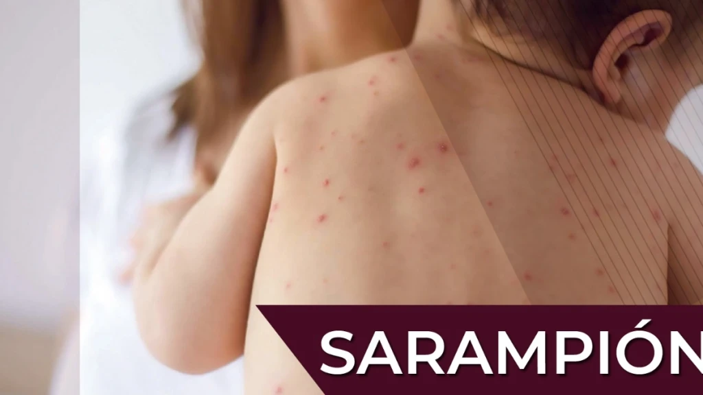 Alerta: Sarampión Dispara 18 Mil Casos en México y Desafía Inmunidad de Rebaño