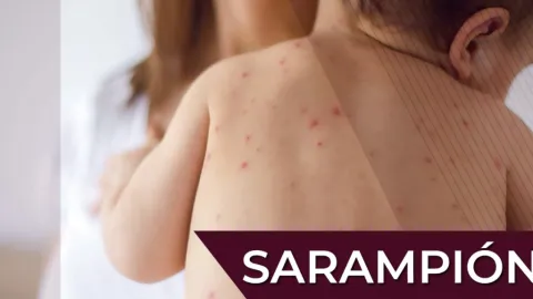 Alerta: Sarampión Dispara 18 Mil Casos en México y Desafía Inmunidad de Rebaño